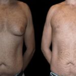 before and after male breast reduction results