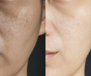 Understanding Skin Whitening Injections: Costs and Effectiveness