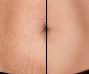 Achieve Your Best Skin with Aesthetic World’s Wrinkles, Scars, and Stretch Marks Treatments!