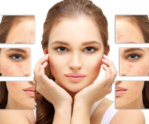 Best Acne Scar Treatment Options: How to Achieve Smooth, Clear Skin