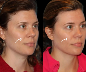 Why Sculptra Stands Out at the Best Aesthetic Clinic in Dubai