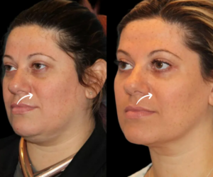The Benefits of Sculptra: Insights from the Best Aesthetics Clinic in Dubai
