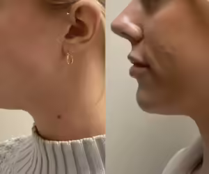 Chin Fillers in Dubai Maintenance: How Often Should You Refill?