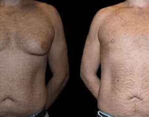 How to Prepare for Your Gynecomastia Surgery Consultation in Dubai