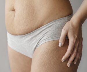 Laser Stretch Mark Removal in Amritsar: A Complete Guide to Flawless Skin