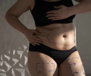 Comprehensive Guide to Stretch Mark Removal Treatment in Amritsar