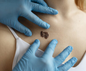 Mole Removal Treatment in Amritsar: Get Clear Skin with Aesthetic World!