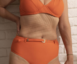 Laser Stretch Mark Removal in Amritsar: The Ultimate Solution for Flawless Skin